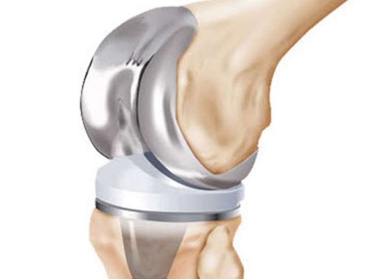 What are high flexibility implants?