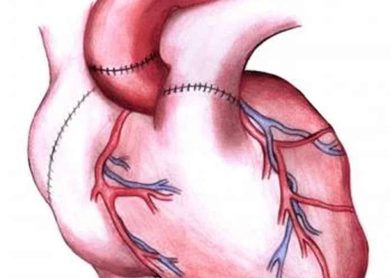 What are the considerations for heart transplant?