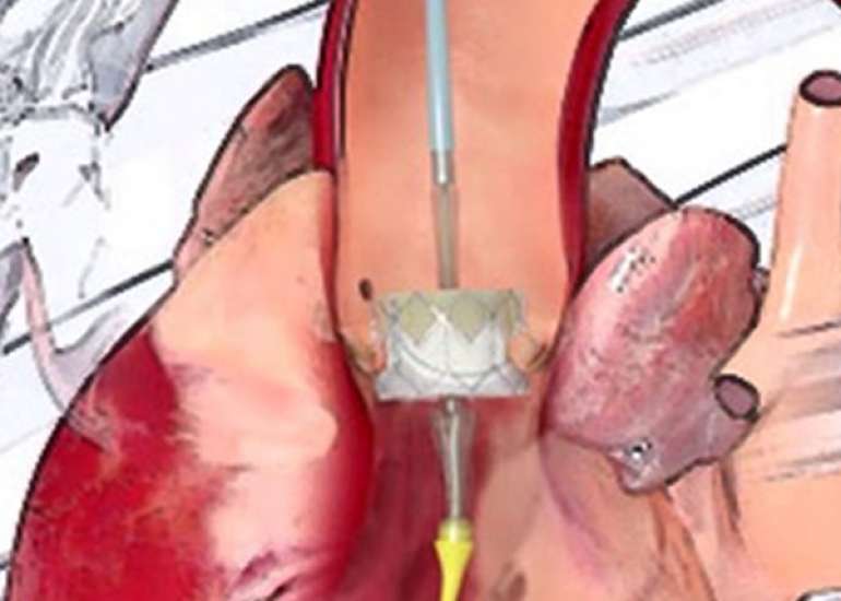 What are the indications for surgery in a case of aortic?