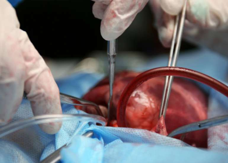 What are the long term results of cardiac transplant?