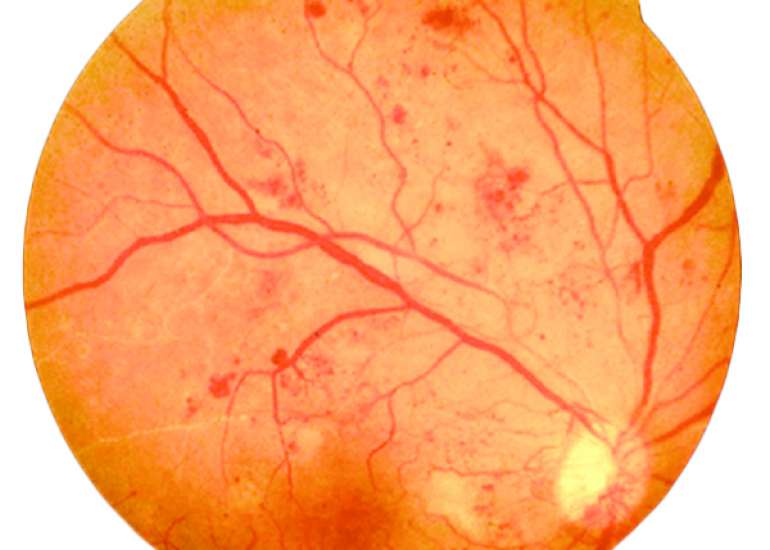 What are the risk factors that lead to Diabetic Retinopathy?