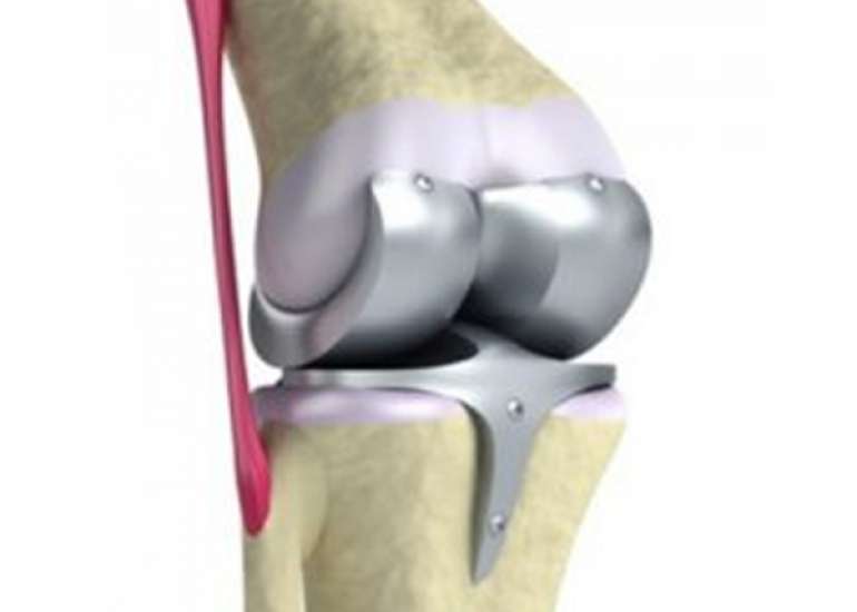 What are the types of orthopedic implants being used and how should we choose an implant?