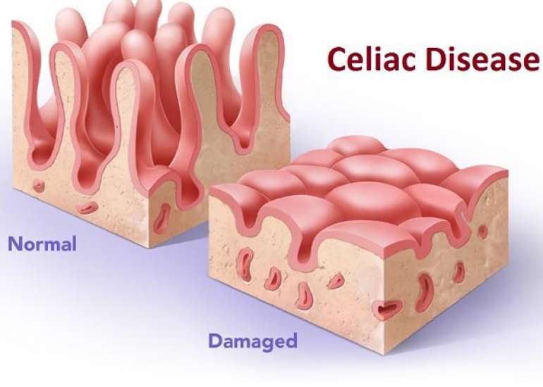 What causes Gluten Intolerance (celiac disease)?