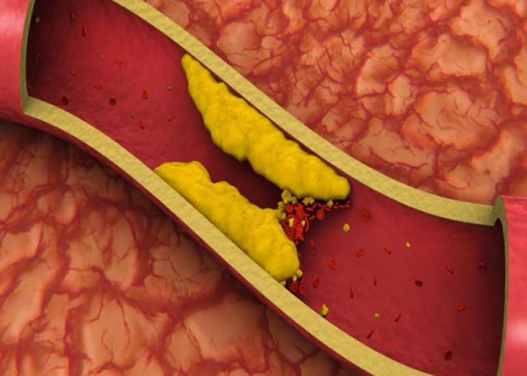 What happens when an artery gets blocked?