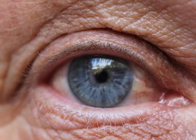 What is Age related macular Degeneration?