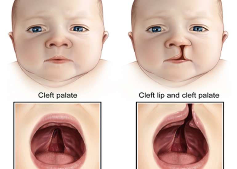 What is Cleft lip and Cleft Palate?