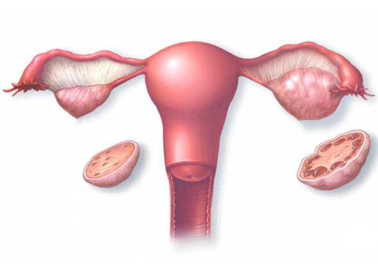 What is PCOS?