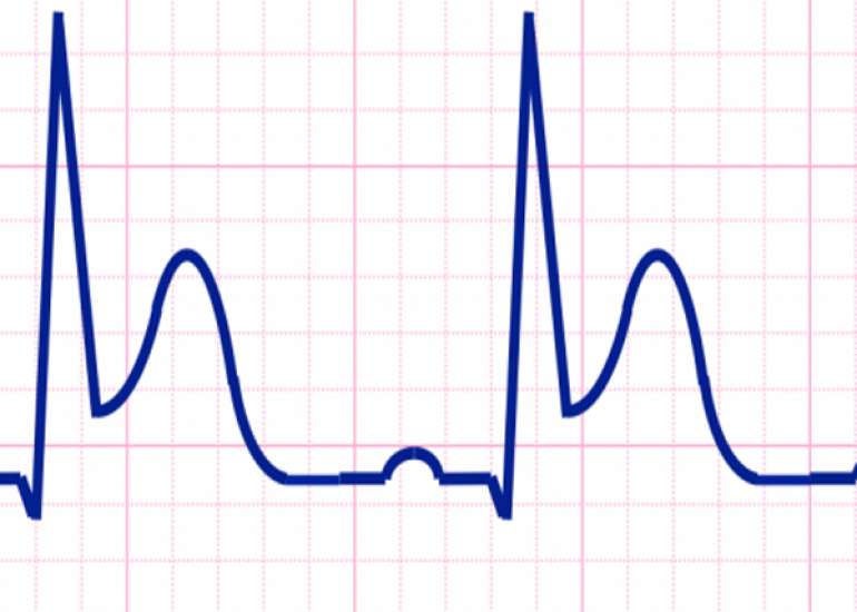 What is ST elevation MI and its preventive measures?
