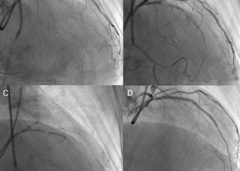 What is best treatment for LAD blockage 80-90%?