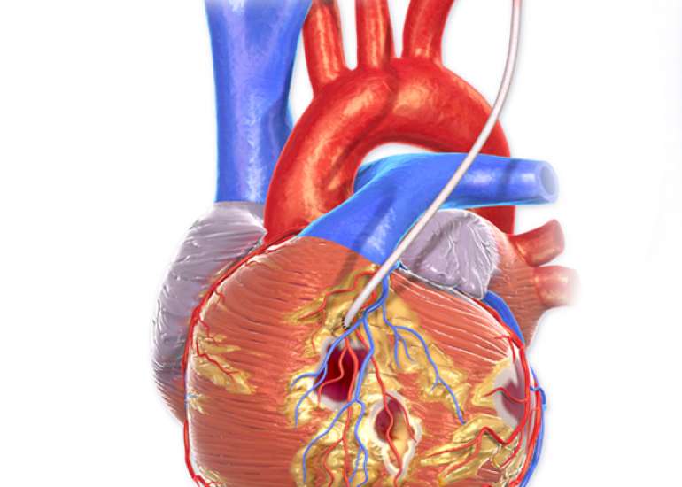 What is bypass surgery without cutting the sternum?