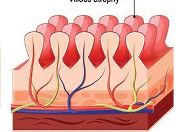 What is celiac disease?