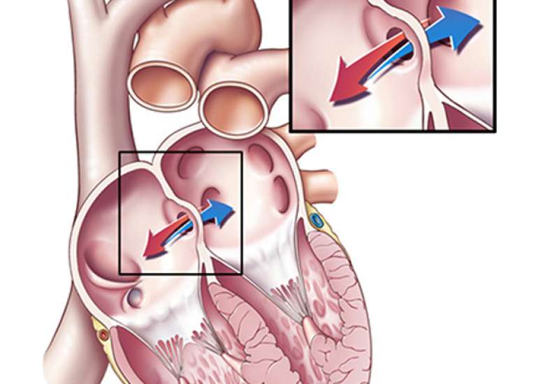 What is considered a large ASD?