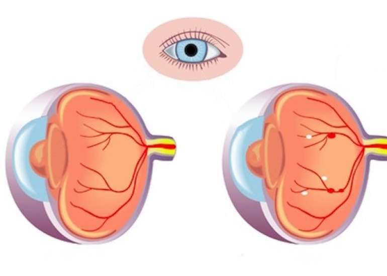What is diabetic retinopathy?