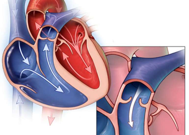 What is feasible, double valve replacement versus single valve replacement or other valve repair?