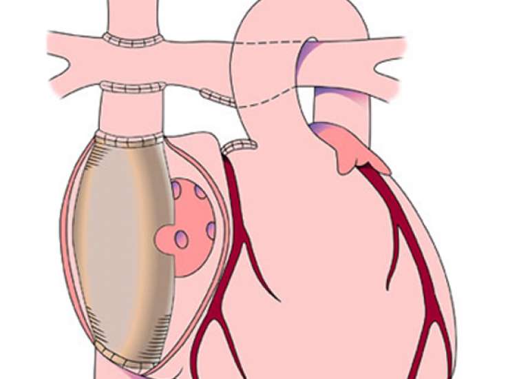 What is fenestration in fontan surgery?