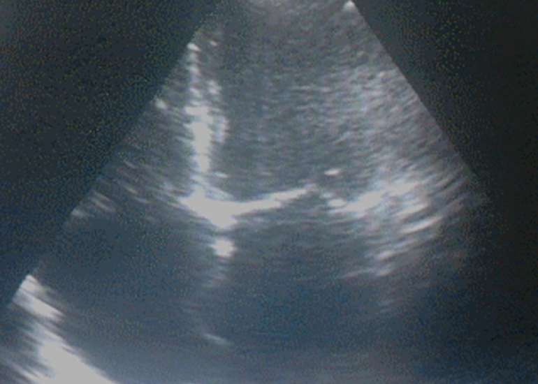 What is interatrial septal aneurysm?