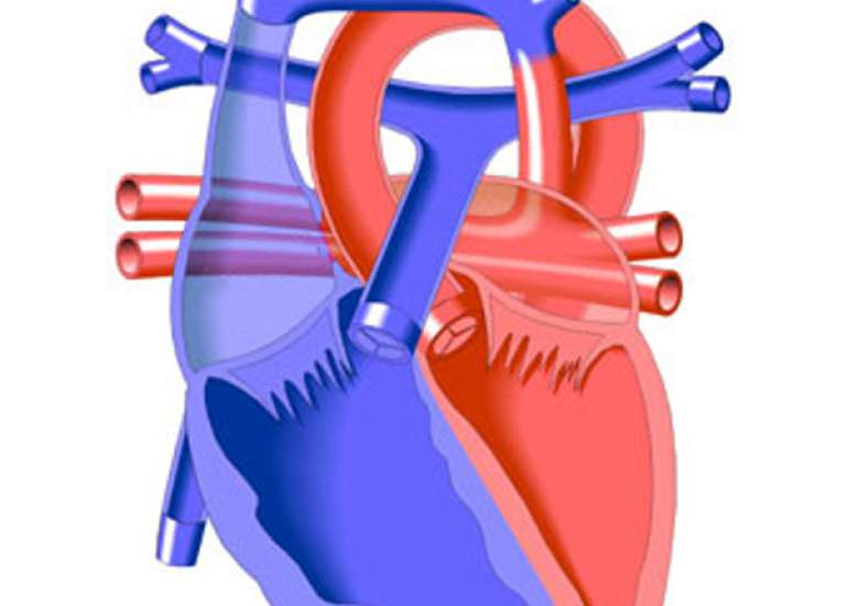What is obstructed TAPVC?
