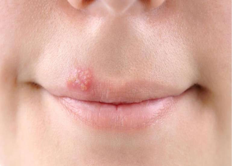 What is pemphigus?