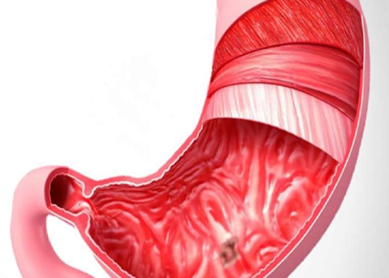 What is peptic ulcer?