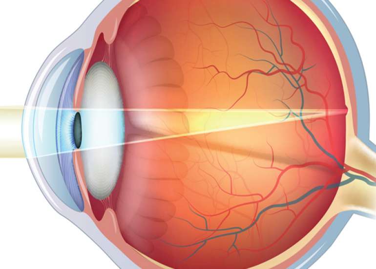 What is refractive error and what are the causes of refractive error?