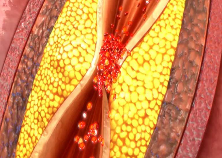 What is stable coronary artery disease?