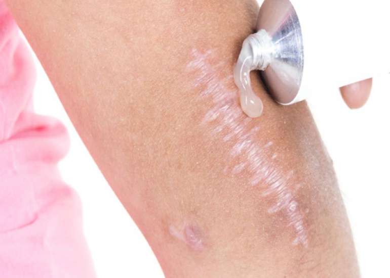 What is the best treatment for scars after surgery?