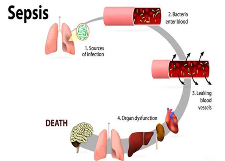 What is the definition of sepsis?