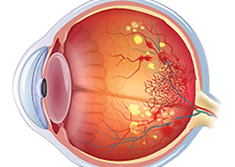 What is the impact of high blood pressure on retina?
