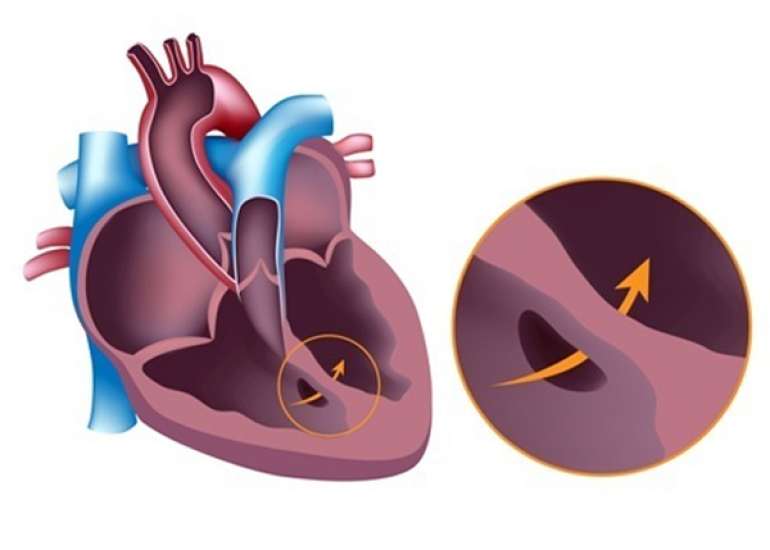 What is ventricular septal defect (VSD)?