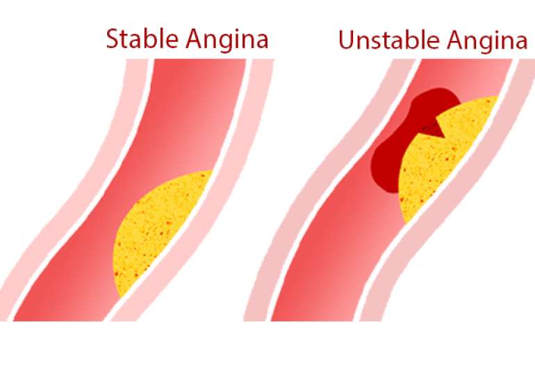 What medical treatment should be given to a patient with stable and unstable angina?