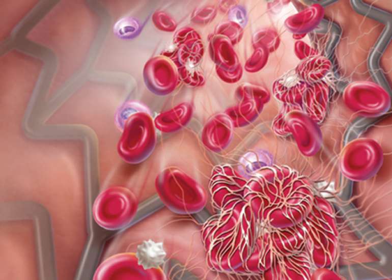 What should be the duration of dual antiplatelet therapy?