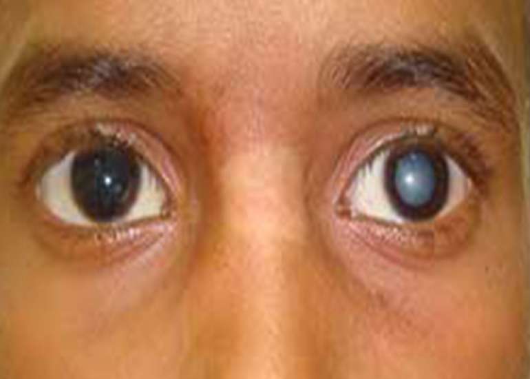 What about Cataract in children?