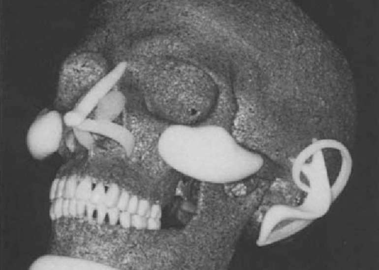 What are polyethylene implants?