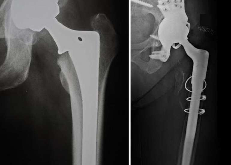 What are revision implants for a second surgery?