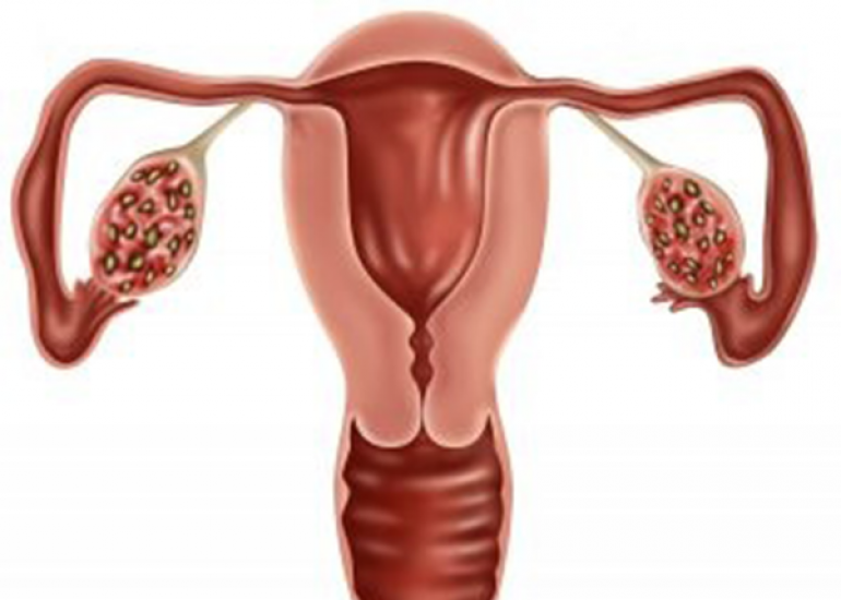 What are the cardial feature for diagnoss of PCOS?