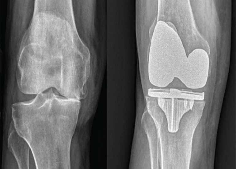 What are the results of total knee replacement?