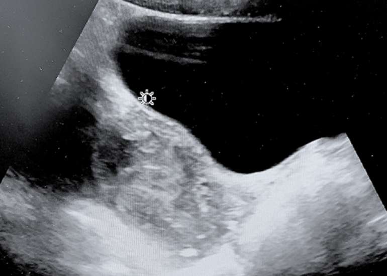 What are the risks of antibiotic therapy failure in women with tubo-ovarian abscesses?