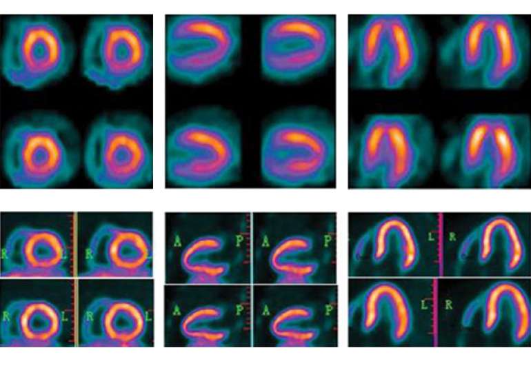 What are the various protocols for nuclear myocardial studies?