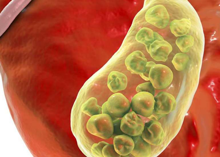 What can happen if gallstones are left untreated?