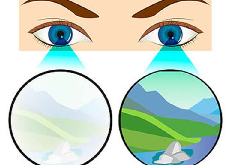 What is Amblyopia or Lazy Eye?