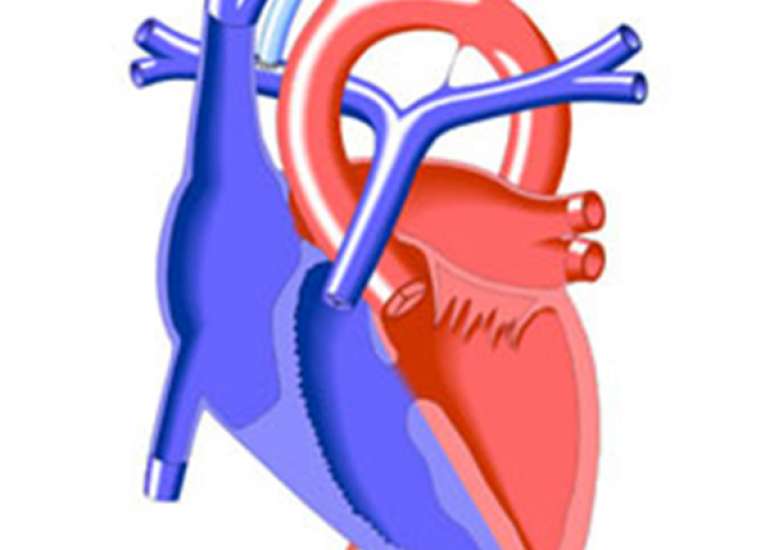 What is BT shunt, left BT shunt, right BT shunt and modified BT shunt?
