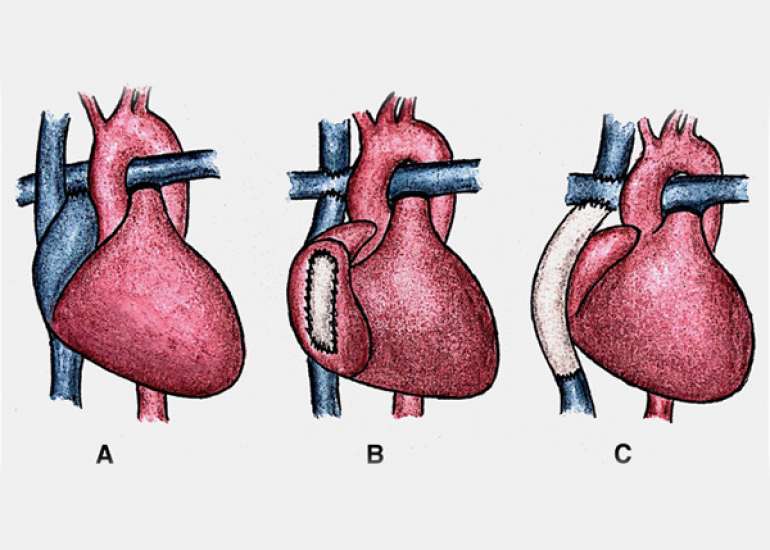 What is fontan surgery?