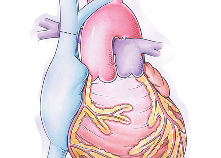 What is glenn surgery?