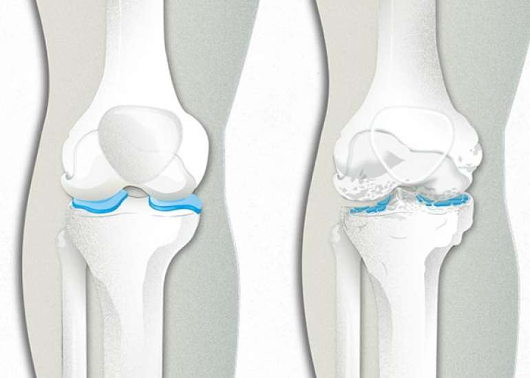 What is Osteoarthritis?