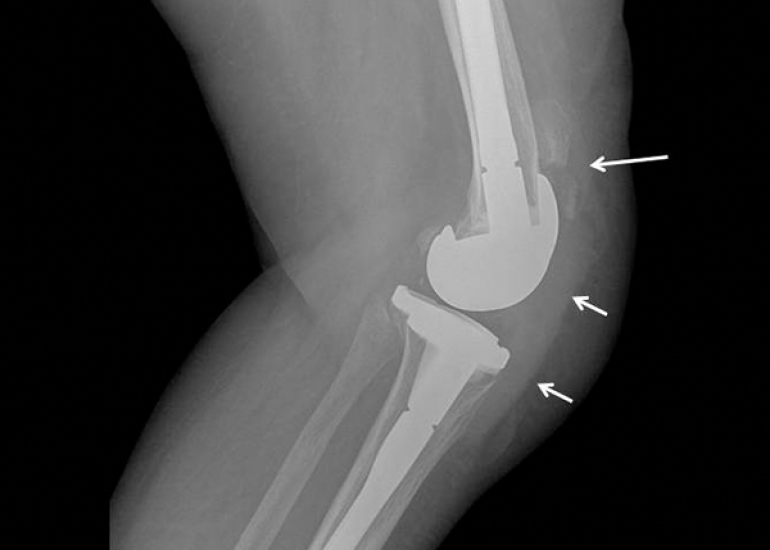 What is Patellar knee replacement?