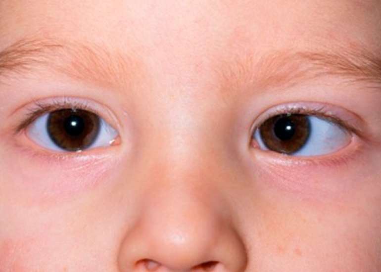 What is Strabismus or Squint?
