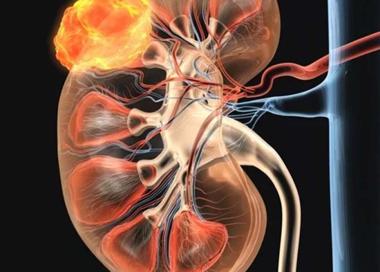 विल्म्स ट्यूमर क्या है? कारण, लक्षण और इलाज | Wilms Tumor in Hindi