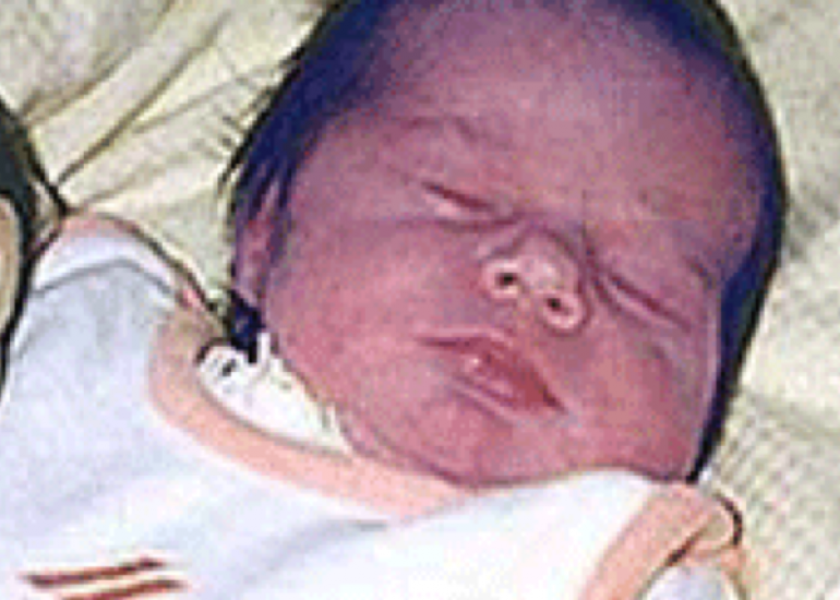 What is a blue baby?