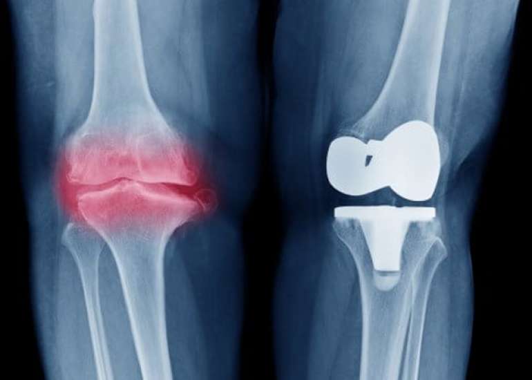 What is a total knee replacement?