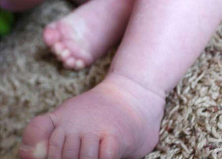 What is cyanotic spell?